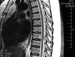 MRI hrudnej chrbtice
