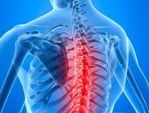 Osteochondróza hrudnej chrbtice