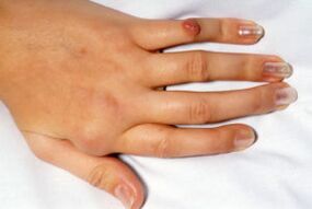 bolesť v deformovaných prstoch