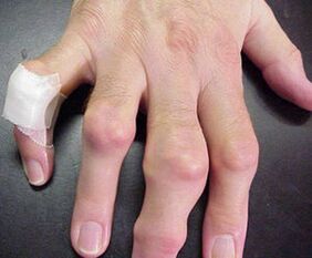 prsty s deformáciami kĺbov spôsobujú bolesť
