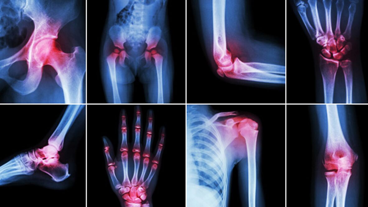 Röntgenové lúče na bolesť kĺbov
