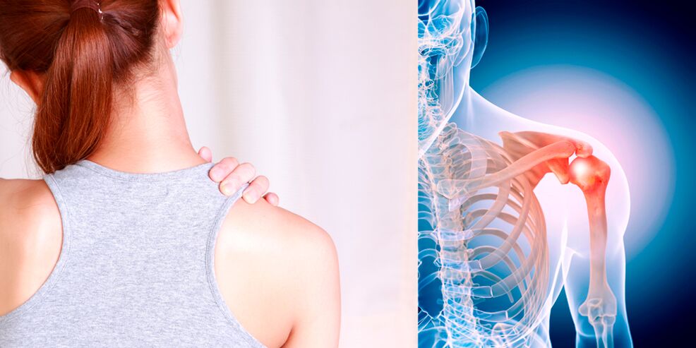 Vývoj artrózy ramena postupne vedie k neustálej bolesti