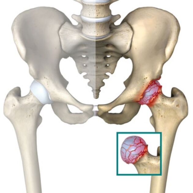 artróza bedrového kĺbu