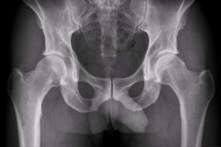 röntgen bedrového kĺbu pre bolesť