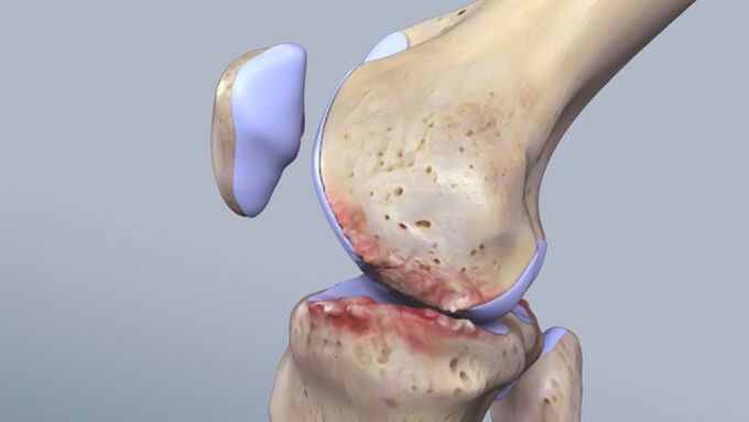 Štruktúra kolenného kĺbu ovplyvnená patológiou
