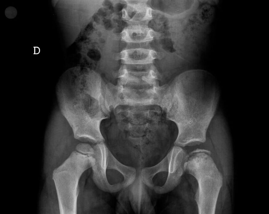 Legg-Calvé-Perthesova choroba – nekróza chrupavkového tkaniva hlavice stehennej kosti