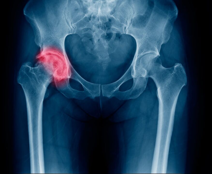 Zlomenina krčka stehennej kosti spôsobujúca bolesť vyžarujúca do nohy