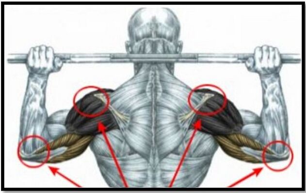 Zaťaženie svalov ramena a lakťa je jednou z príčin artrózy ramenného kĺbu