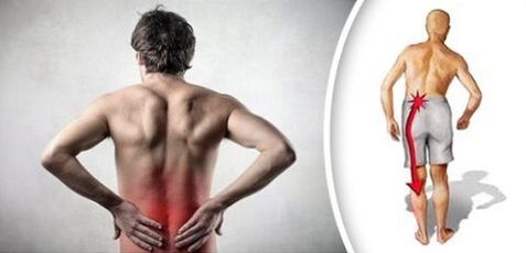 Syndróm bolesti s bedrovou osteochondrózou vyžaruje na nohách