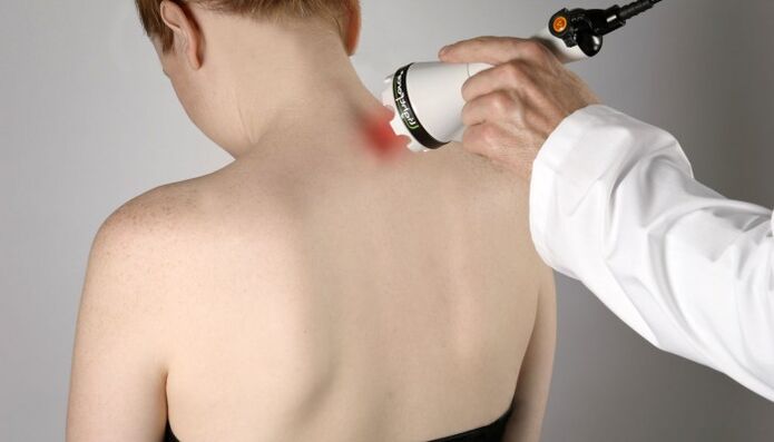 laserová terapia cervikálnej osteochondrózy